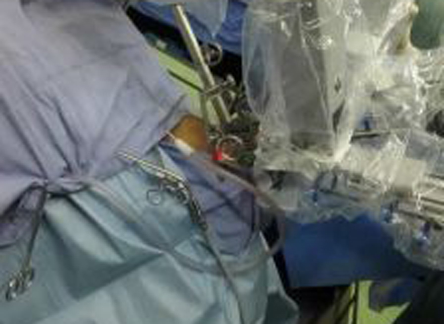 北京安貞醫(yī)院用多功能顯微支撐喉鏡做會厭癌切除手術